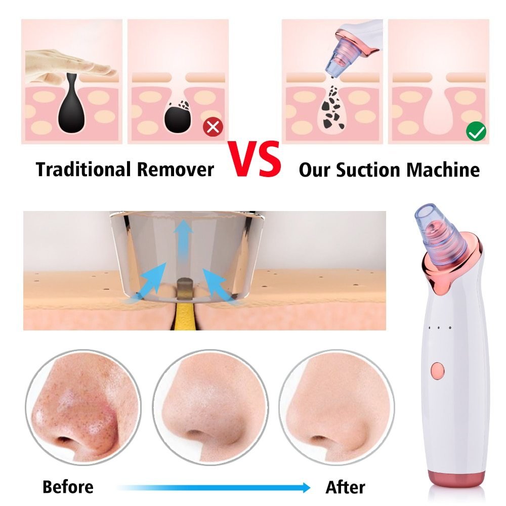 Facial Acne Cleaning Blackhead Suction Instrument - Image 8